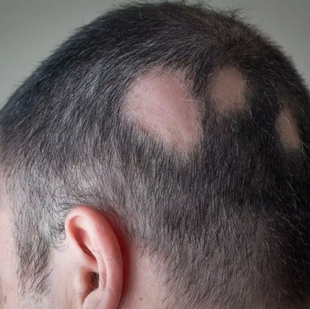 Alopecia areata treatment in Nagpur by Dr Shruti Gunashekhar at Cleaura Clinic