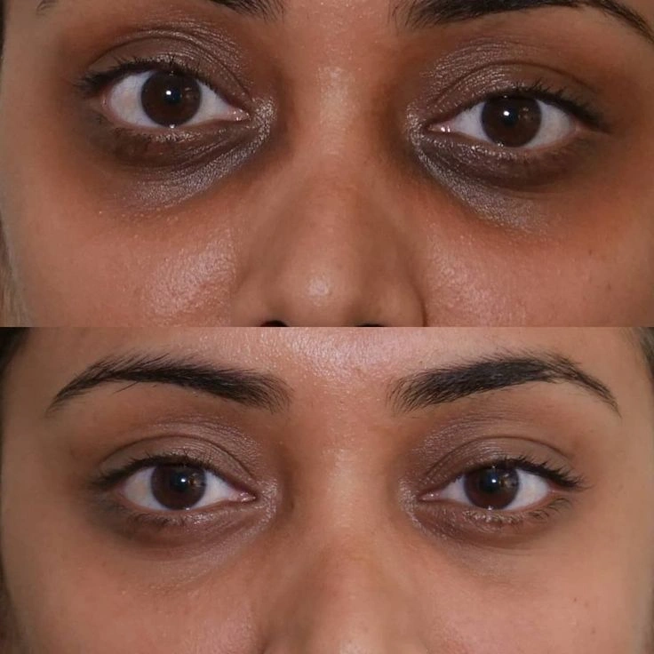 Dark circles treatment in Nagpur at Cleaura Clinic