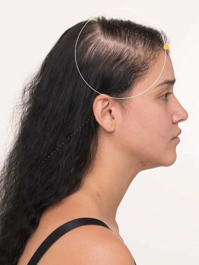 Female pattern hair loss crown thinning and widening parting — diagnosis at Cleaura Clinic Nagpur by Dr. Shruti Gunashekhar