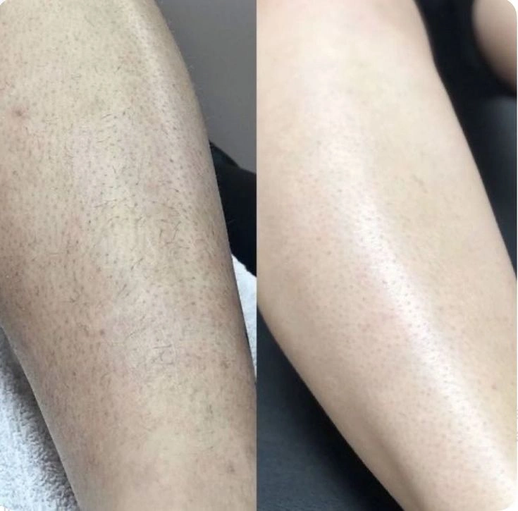 Full Leg laser hair removal before after transformation at Cleaura Nagpur