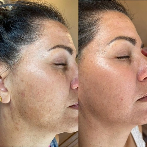 Melasma laser treatment results at best clinic in Nagpur