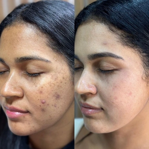 Melasma treatment before and after results at Cleaura Clinic Nagpur