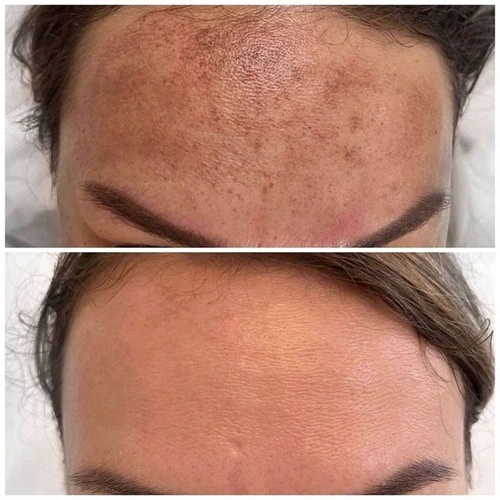 Hormonal melasma treatment results on Indian skin at Cleaura Nagpur