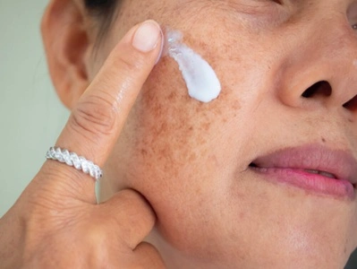 Melasma cream treatment with Tranexamic Acid and Azelaic Acid at Cleaura Clinic Nagpur