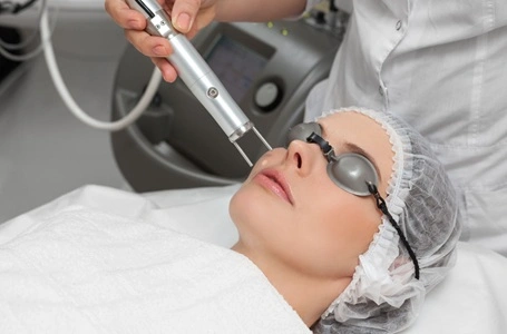 Melasma laser treatment session at Cleaura Clinic Nagpur