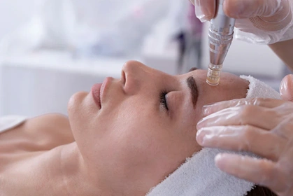 Microneedling with Vitamin C and Glutathione for melasma at Cleaura Nagpur
