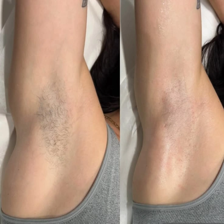 Underarm laser hair removal before and after results in Nagpur