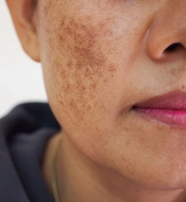 Hormonal melasma on face in Indian women — Cleaura Nagpur