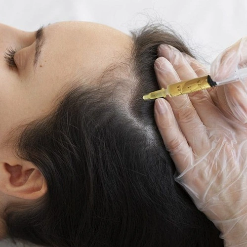 Diagram showing mesotherapy injection delivering nutrients to hair follicle in scalp at Cleaura Clinic Nagpur