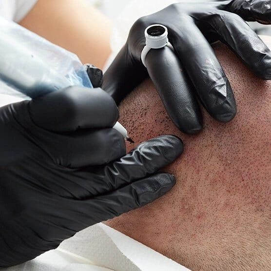 Scalp micropigmentation result showing natural hair follicle dots — Cleaura Clinic Nagpur